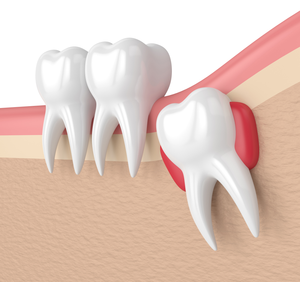 Sinus Lift